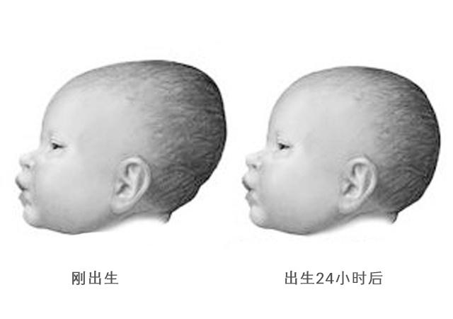 关于四个月宝宝囟门情况表的研究与探讨