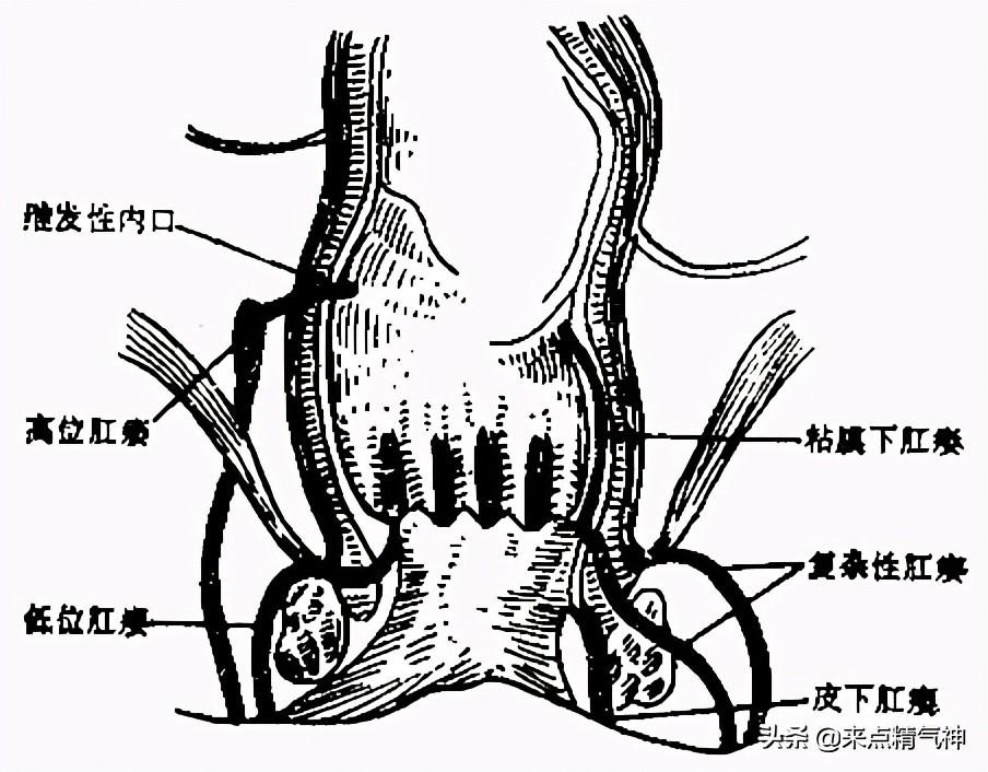 肛瘘手术后一个月的恢复与护理